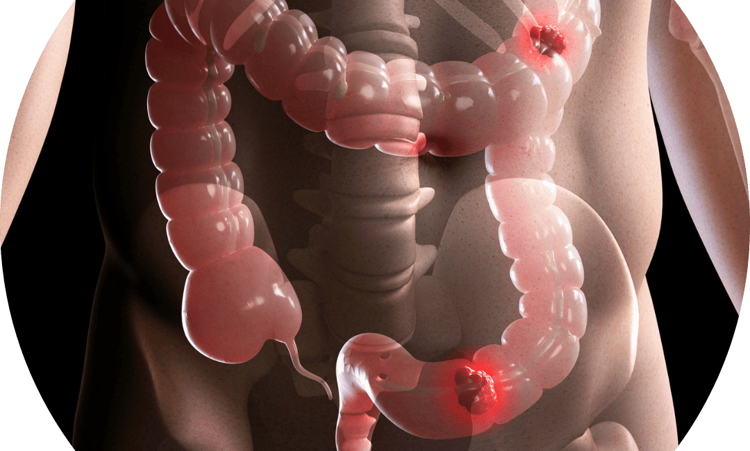 Síndrome do intestino irritável​