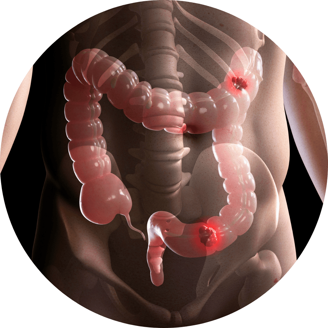 Síndrome do intestino irritável​