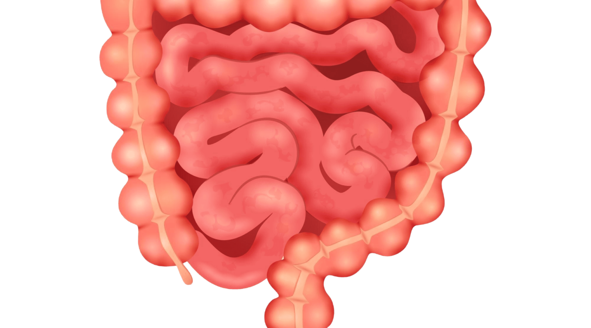 Divertículos Colonicos