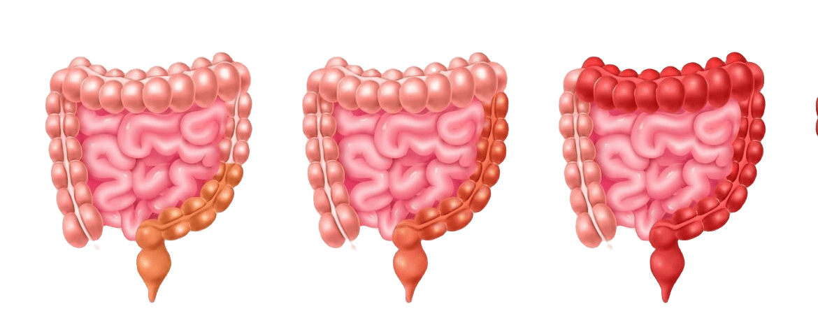 Retocolite Ulcerativa